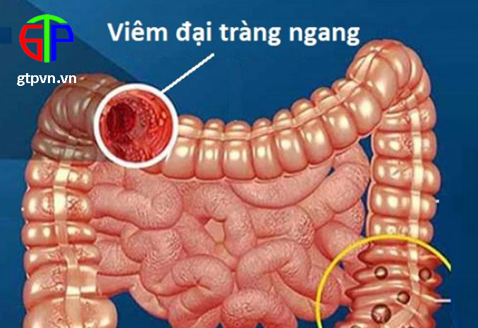 Các bệnh thường gặp ở đại trực tràng Nguyên nhân, triệu chứng và cách phòng ngừa
