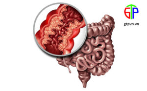 Viêm đường ruột – Nguyên nhân, triệu chứng và cách phòng ngừa hiệu quả