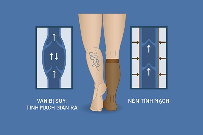 Suy Giãn Tĩnh Mạch - Enzyme Enbio