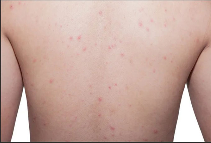 Xịt mụn da lưng Biolung Back – Lựa chọn thông minh cho làn da khỏe mạnh